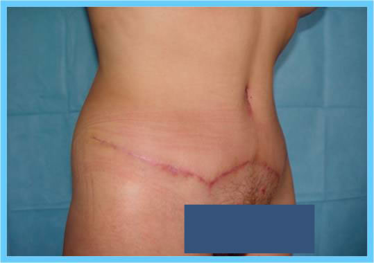 cirugia estetica de abdomen